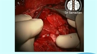 عمل جراحی مننژیوم قاعده جمجمه با گسترش به کره چشم