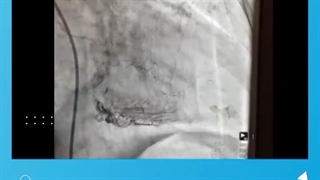 آنژیوپلاستی اورژانسی