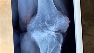 تعویض مفصل زانو در بیمار مبتلا به آرتروز شدید همراه با فیوژن زانو