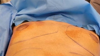 فیلم بدون سانسور جراحی کوچک کردن سینه در آقایان