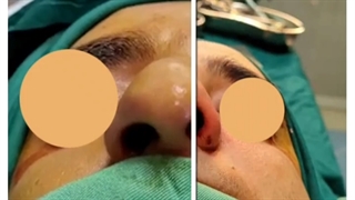 جراحی زیبایی بینی گوشتی با قوز شدید در آقایان