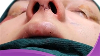 فیلم بدون سانسور جراحی زیبایی بینی
