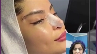 هزینه انواع روش های لیفت شقیقه