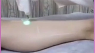 لیزر بیکینی (واژن) هزینه،خطرات، مزایای بی نظیر به همراه عکس