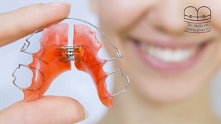انواع ارتودنسی | دکتر احسان ابوئی مهریزی
