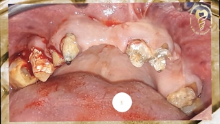 بازسازی کامل فک بالا با ۸ ایمپلنت همزمان با  تقویت استخوان تخریب شده