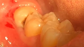 جراحی دندان عقل