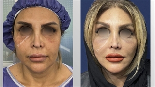 لیفت صورت و گردن و لیفت اندوسکوپی پیشانی | دکتر خوروش