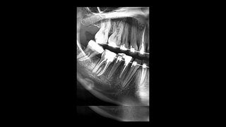 ارتودنسی بجای ایمپلنت | دکتر داودیان