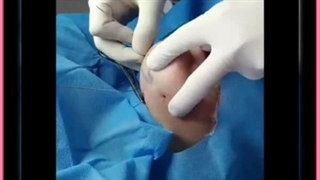 لیفت یا درمان غبغب با روش های بدون جراحی