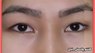 کانتوپلاستی (Canthoplasty) یا عمل چشم گربه ای چیست ؟