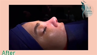 عمل همزمان رینو و ماموپلاستی