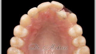 حرکت ارتودنسی دندان ها | دکتر احسان ابوئی مهریزی