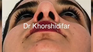 نتیجه جراحی رینوپلاستی