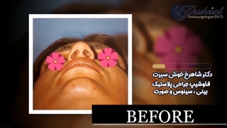 جراحی زیبایی بینی | دکتر شاهرخ خوش سیرت