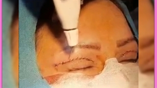 عوارض جراحی پلک