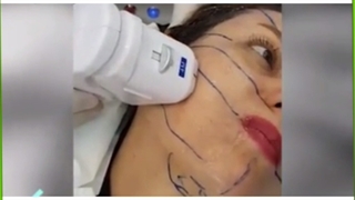 هایفوتراپی معجزه جوانسازی و لیفت صورت/هزینه و مزایا برداشتن توده