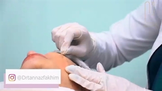 اندولیفت در کلینیک جردن
