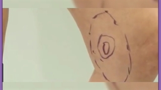 تزریق چربی در بهترین مرکز پوست و مو در تهران