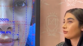 نمونه تزریق چربی به صورت به روش بایوفت