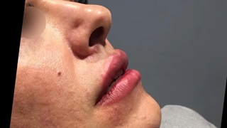 فیلم واقعی تزریق ژل لب در مطب دکتر آزیتا مولازاده