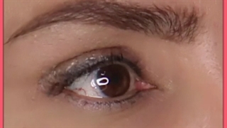 جراحی پلک یا بلفاروپلاستی – هزینه و توصیه ها