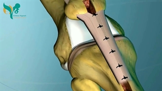 جراحی پارگی رباط صلیبی