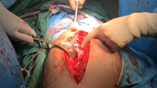 تعویض مفصل لگن