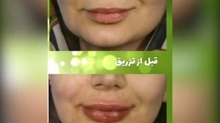 قبل و بلافاصله بعد از تزریق فیلر لب | دکتر یحیوی