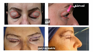 اصلاح افتادگی غده اشکی در حین جراحی پلک پیشرفته | دکتر یحیوی