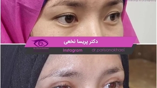 بلفاروپلاستی