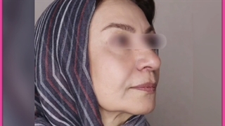 مراقبت های بعد از هایفوتراپی
