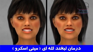 درمان لبخند لثه ای با مینی اسکرو | دکتر احسان ابوئی مهریزی