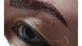 نمونه فیبروز ابرو