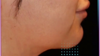 لیفت یا درمان غبغب با روش های بدون جراحی