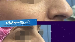 جراحی زیبایی بینی استخوانی