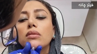فیلر چانه