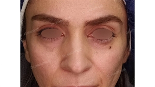 فیلم تزریق چربی صورت به روش اروپایی پوسیدگی دندان