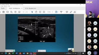Diagnosis And Management Of Thyroid Nodules - قسمت 4