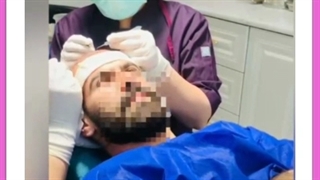 هزینه، مزایا و مراحل کاشت مو به روش میکروگرافت