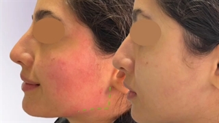 تزریق فیلر به گونه و زاویه فک رفع چین و چروک