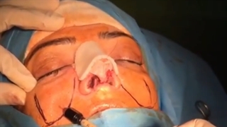 فیلم تزریق چربی همزمان با عمل بینی | دکتر شاهرخ خوش سیرت