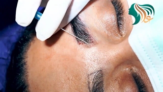 فیلم واقعی کاشت ابرو