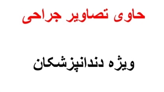 جراحی پیشرفته لیفت لثه (دکتر بهمن پوراقدم)02122220000