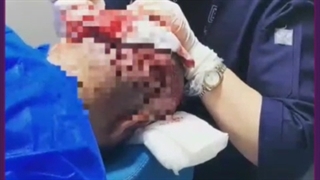 هزینه،  معایب و مزایای کاشت مو به روش سوپر ترکیبی