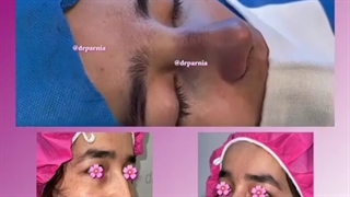 جراحی زیبایی بینی