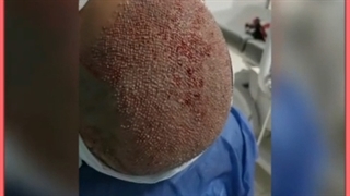 مراحل مزایا و هزینه کاشت مو به روش SUPER FUE