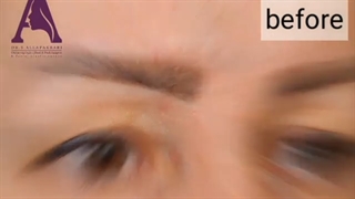 جراحی زیبایی بلفاروپلاستی پلک بالا