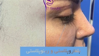 فیلم بلفاروپلاستی و رینوپلاستی