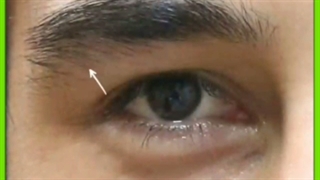 عوارض جراحی پلک